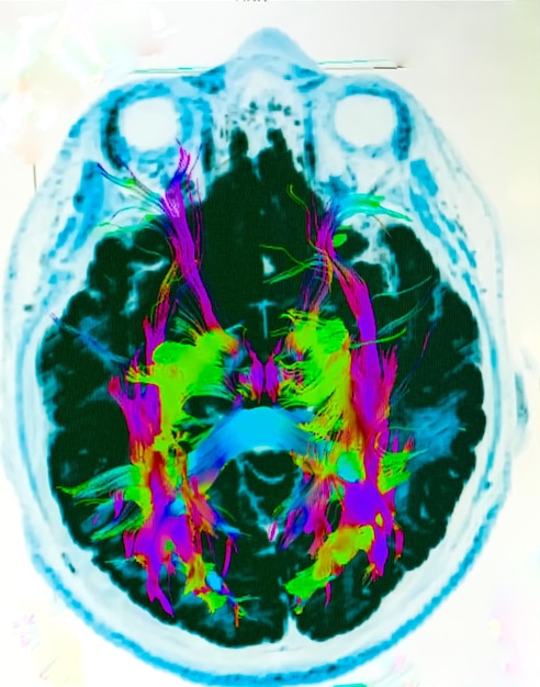 Brain scan imagery highlighting areas of increased activity and stress response, contrasting a brain experiencing digital overload with a brain in a relaxed, focused state.